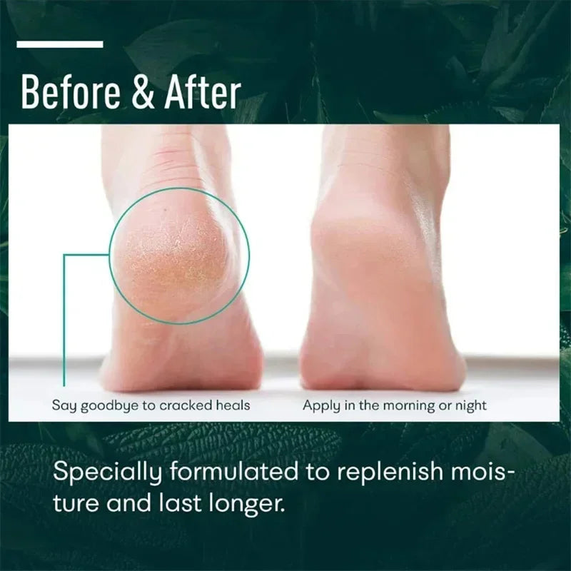 Herbal Anti-Crack Foot Cream – Heel Repair, Dead Skin Removal & Moisturizing Treatment