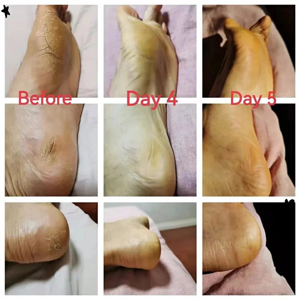 Herbal Anti-Crack Foot Cream – Heel Repair, Dead Skin Removal & Moisturizing Treatment
