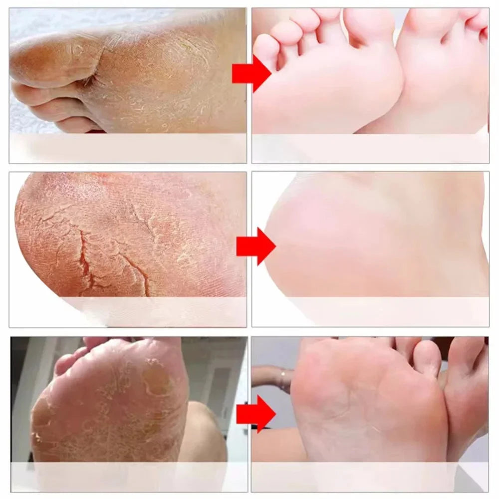 Herbal Anti-Crack Foot Cream – Heel Repair, Dead Skin Removal & Moisturizing Treatment