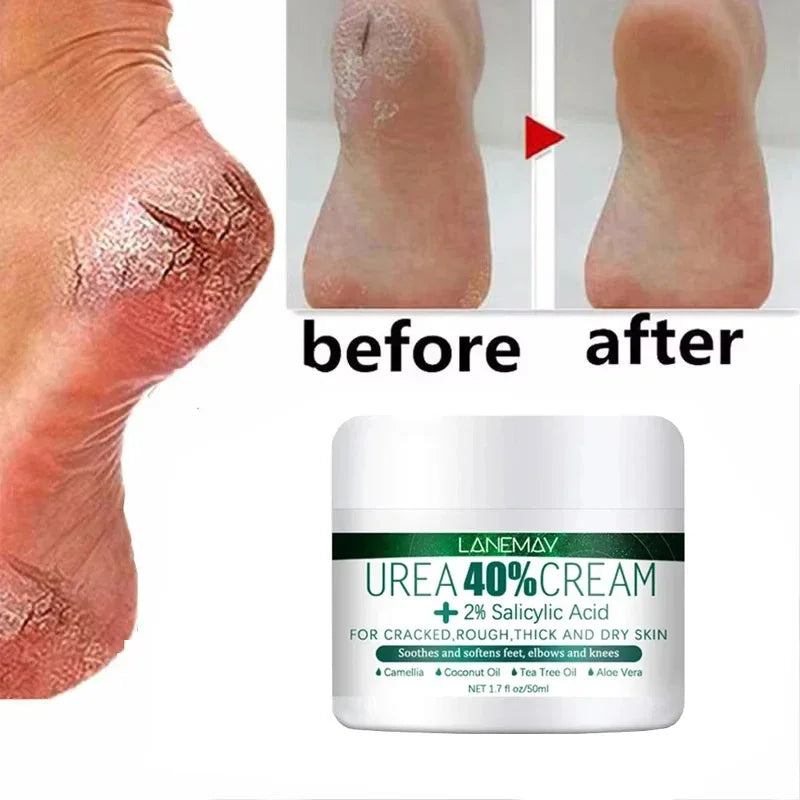 Herbal Anti-Crack Foot Cream – Heel Repair, Dead Skin Removal & Moisturizing Treatment