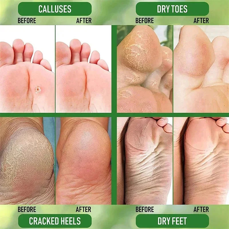 Herbal Anti-Crack Foot Cream – Heel Repair, Dead Skin Removal & Moisturizing Treatment